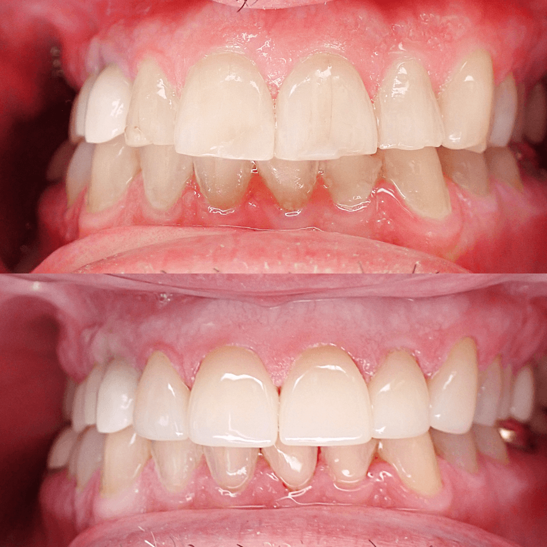 Dental Crowns before and after treatment