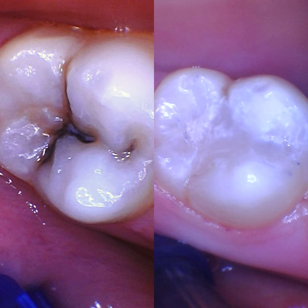 Dental Filling before and after treatment