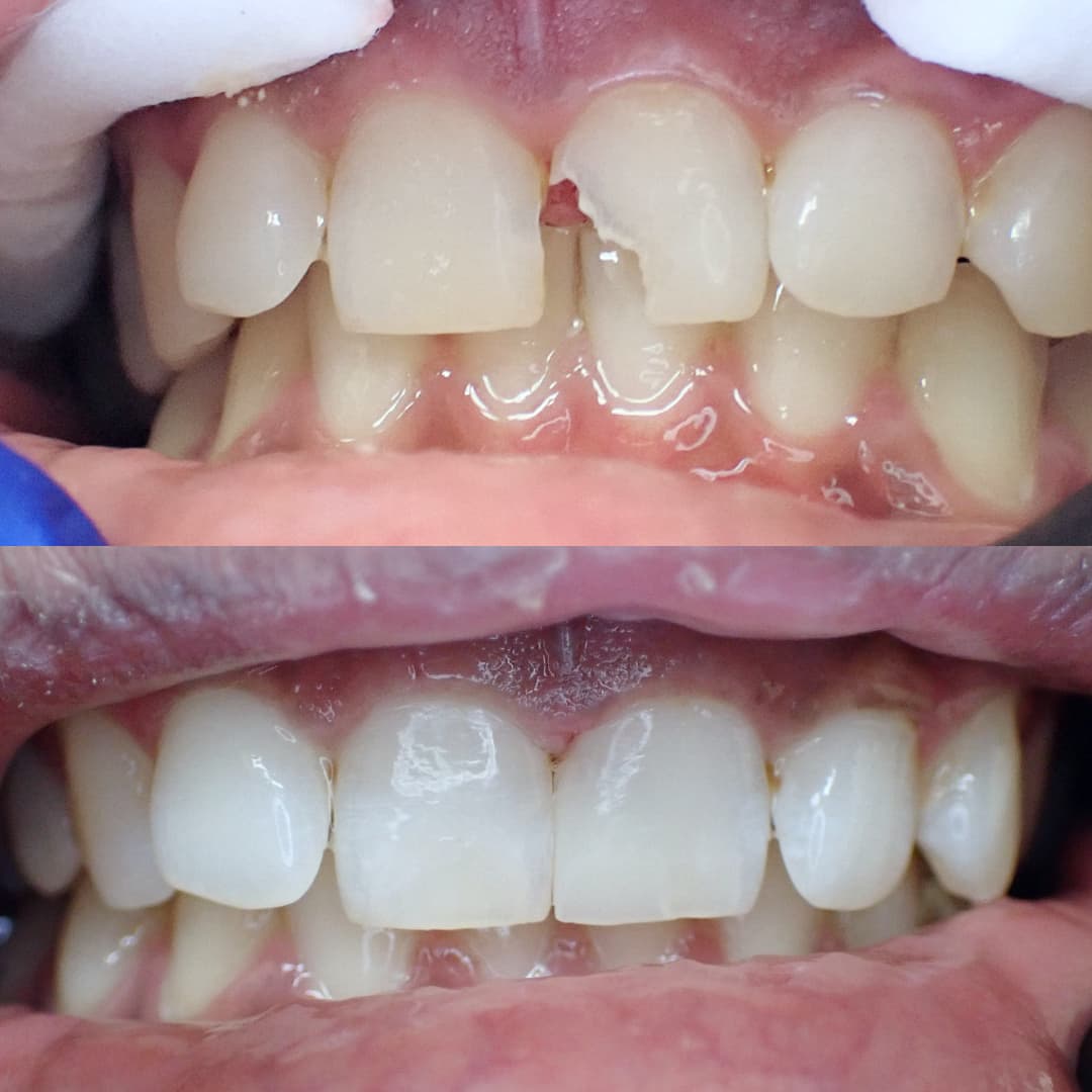 Dental bonding being shaped on a front tooth