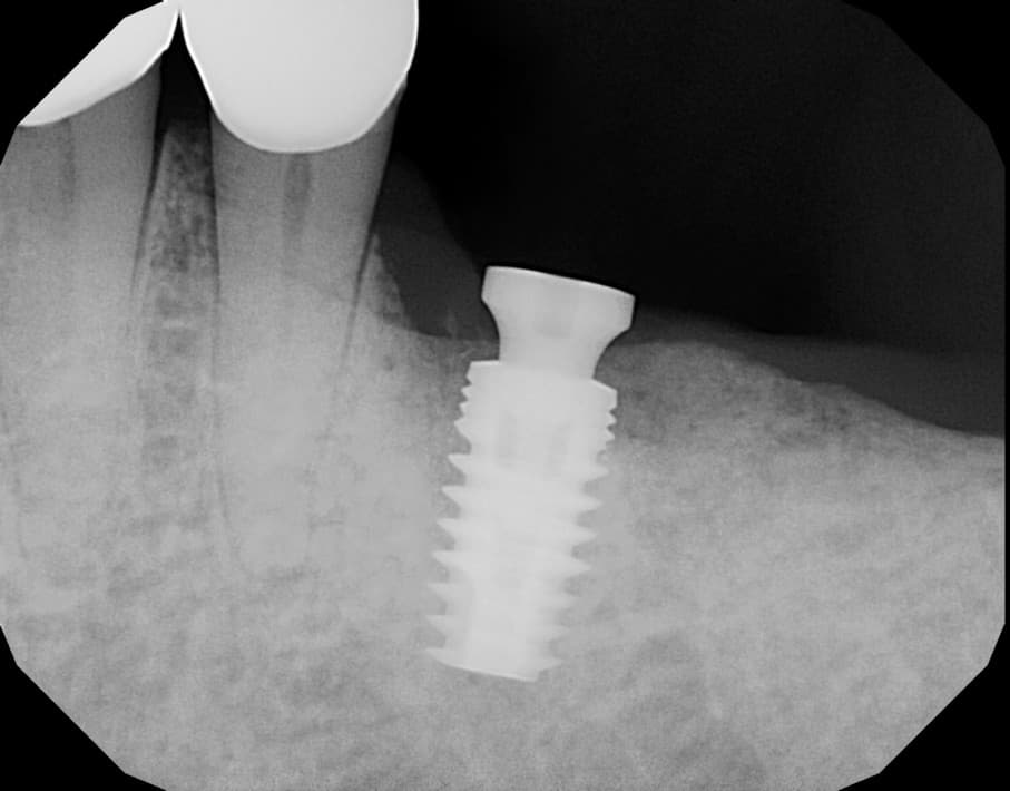 3D model of a dental implant placed in the jaw