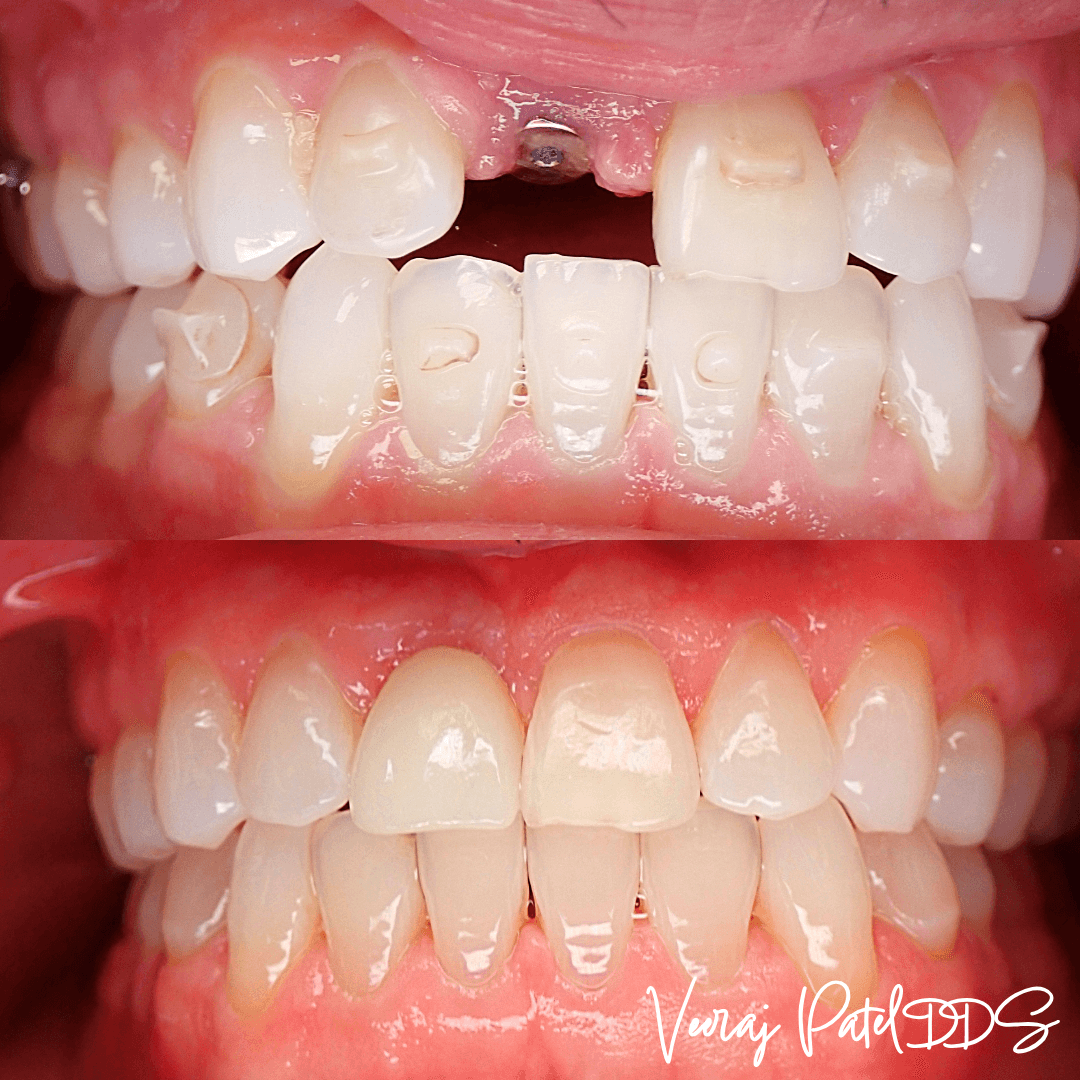 Dental Implant before and after treatment
