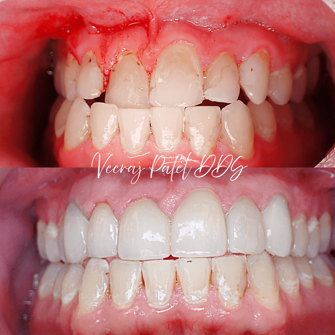 Smile Makeover before and after treatment