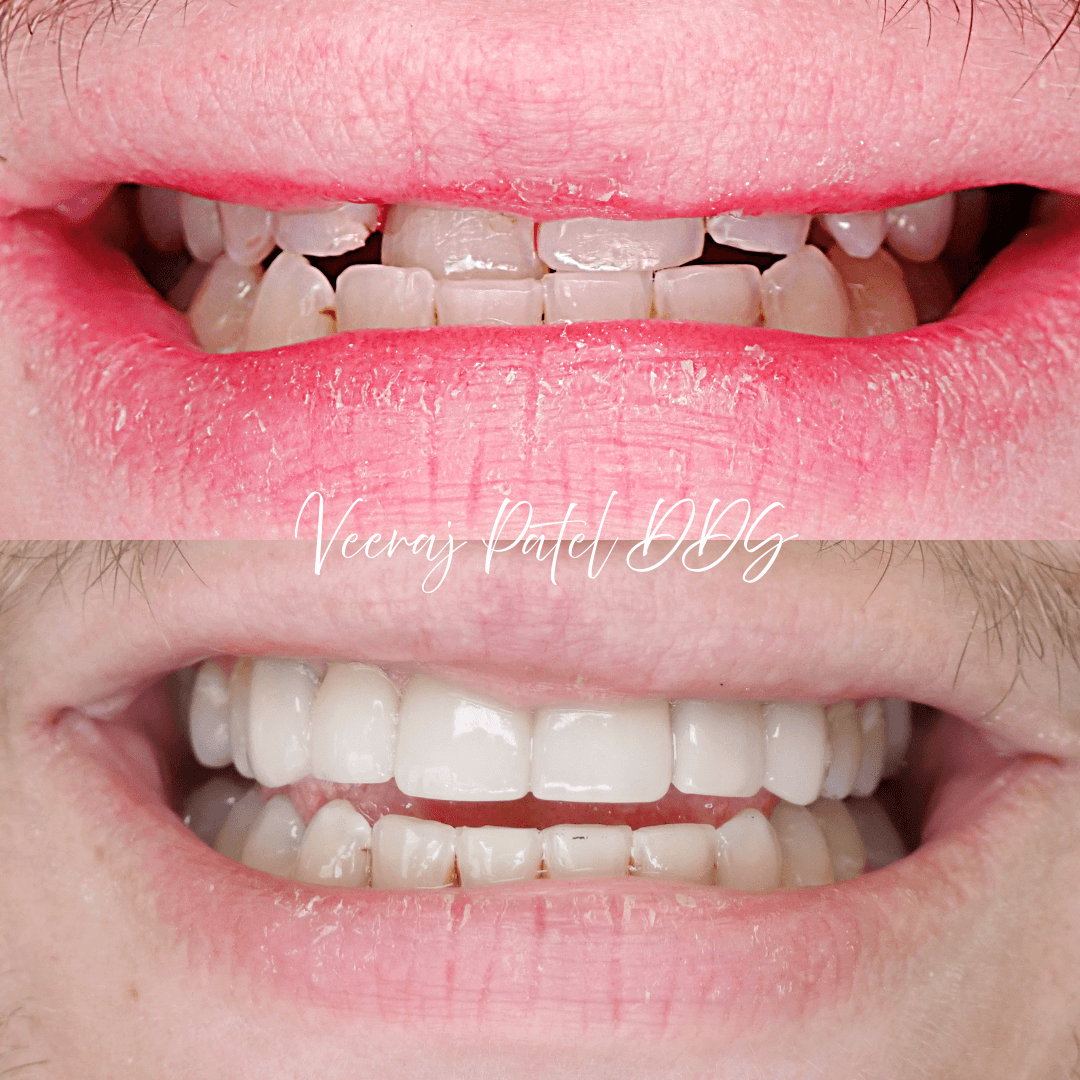 Smile Makeover before and after treatment
