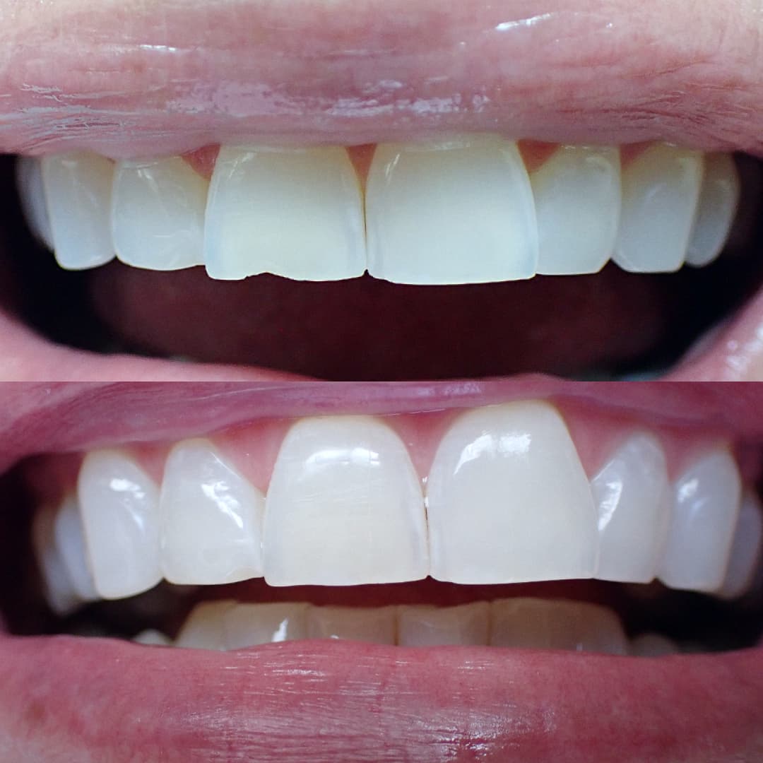 Porcelain Veneers before and after treatment