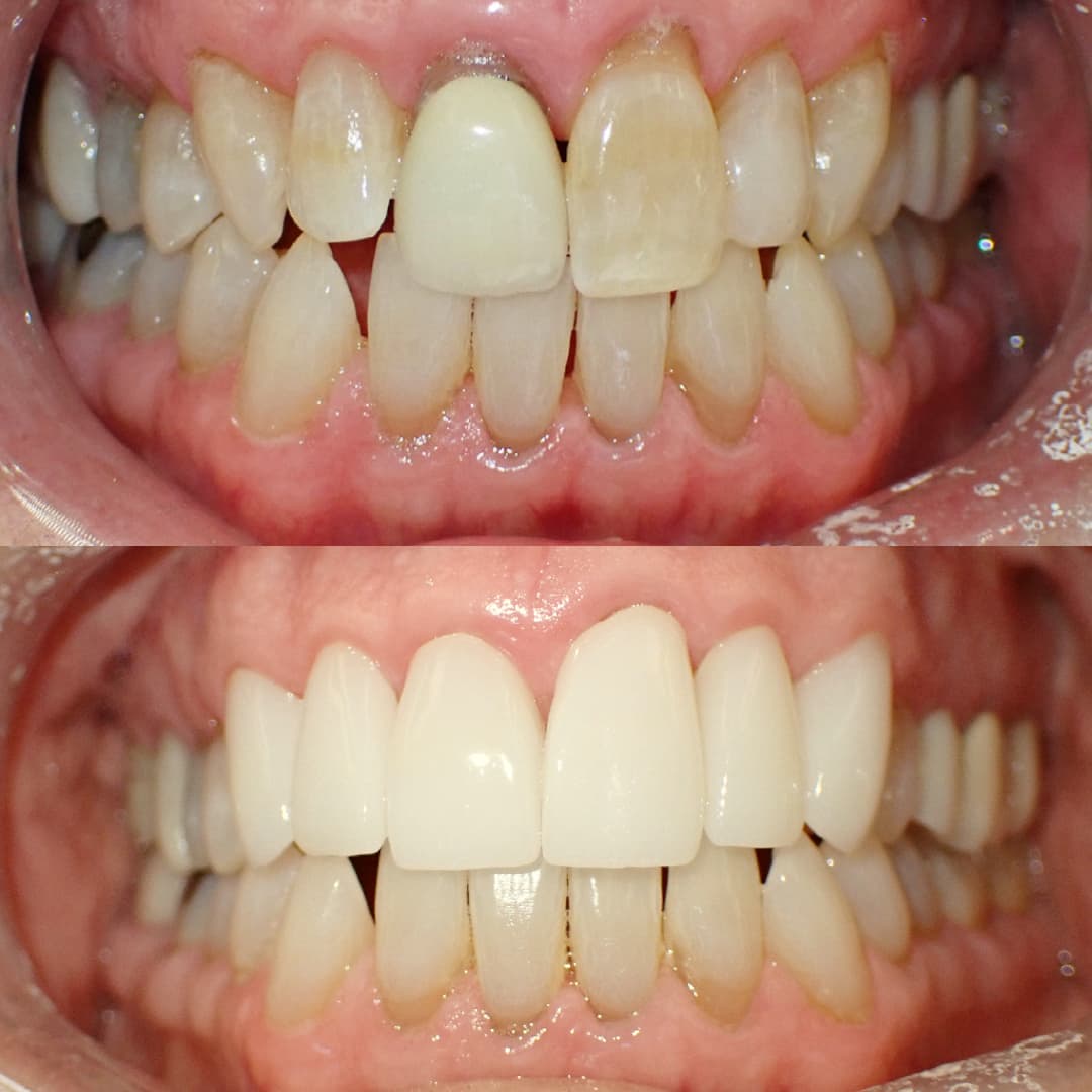 Dental Crown before and after treatment
