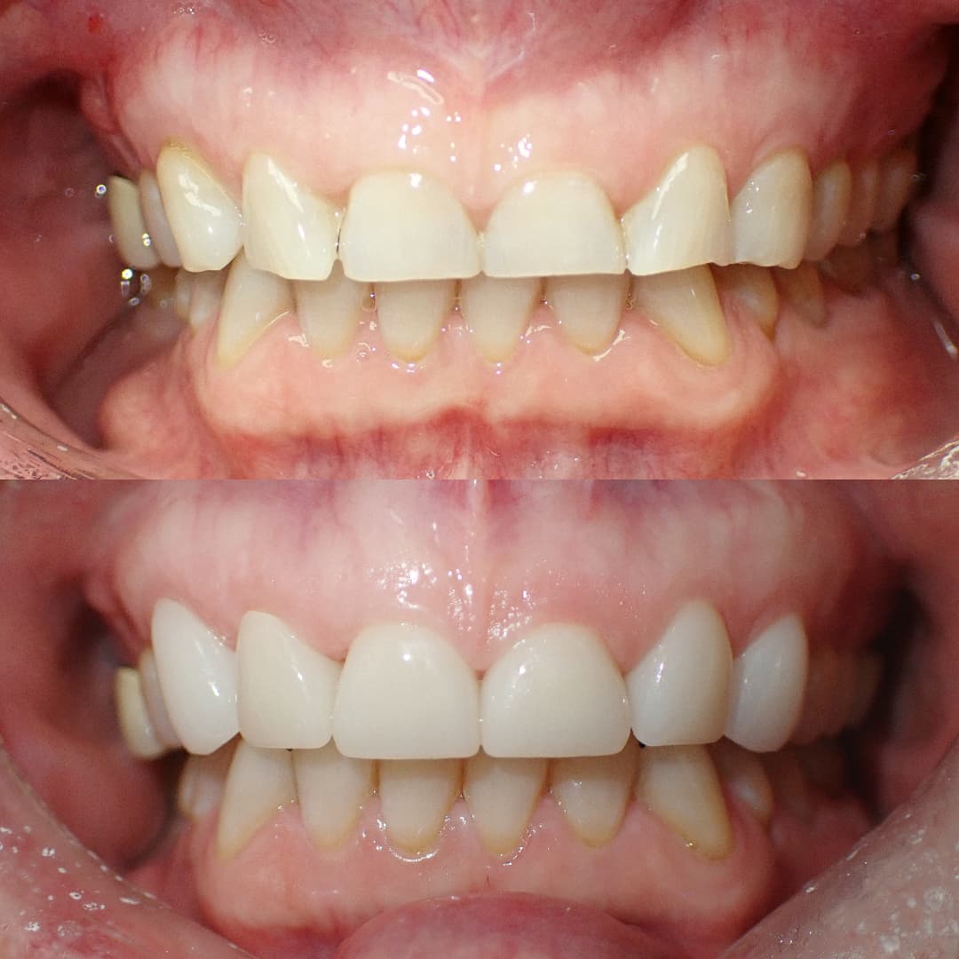 Smile Restoration before and after treatment