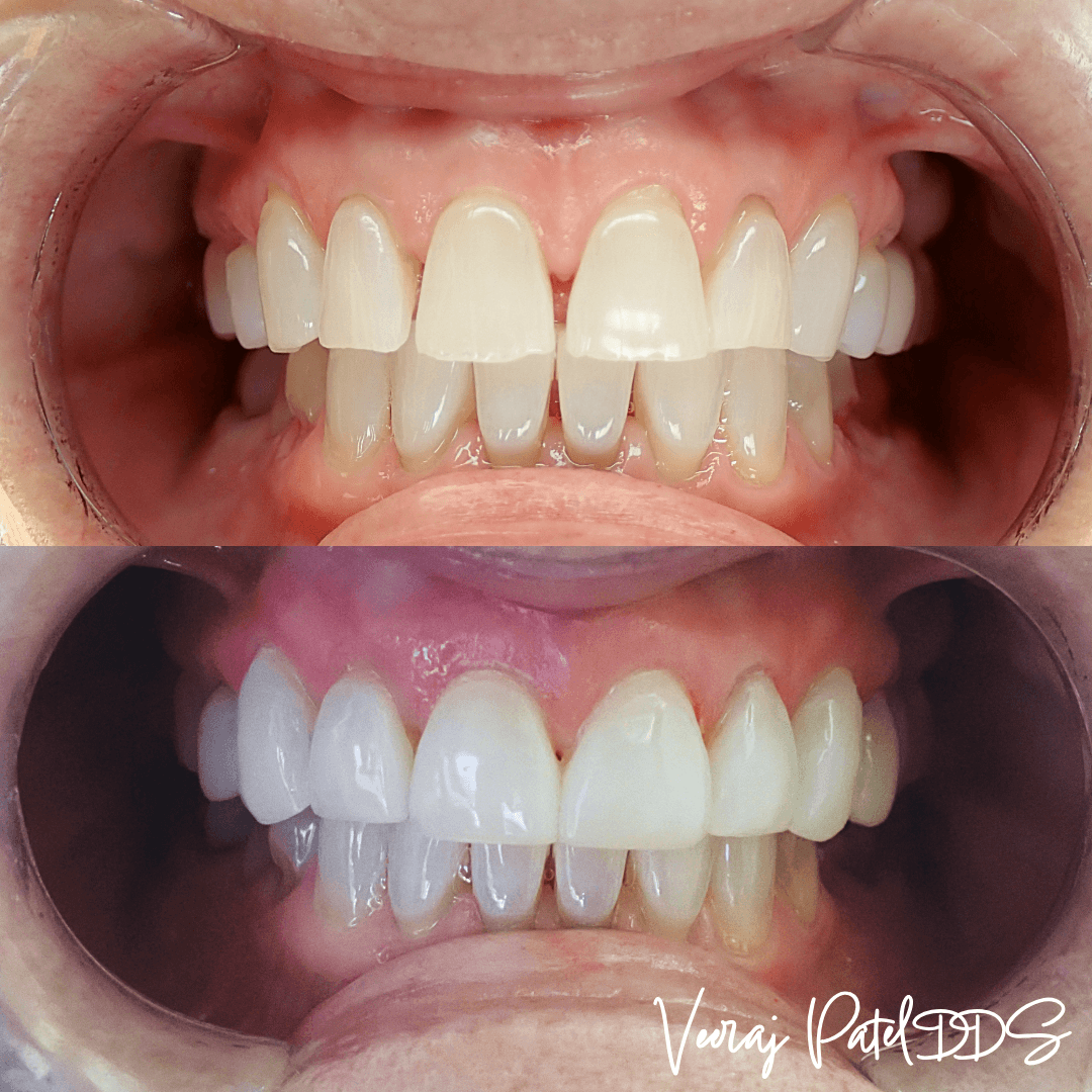 Close-up of a refined smile with porcelain veneers