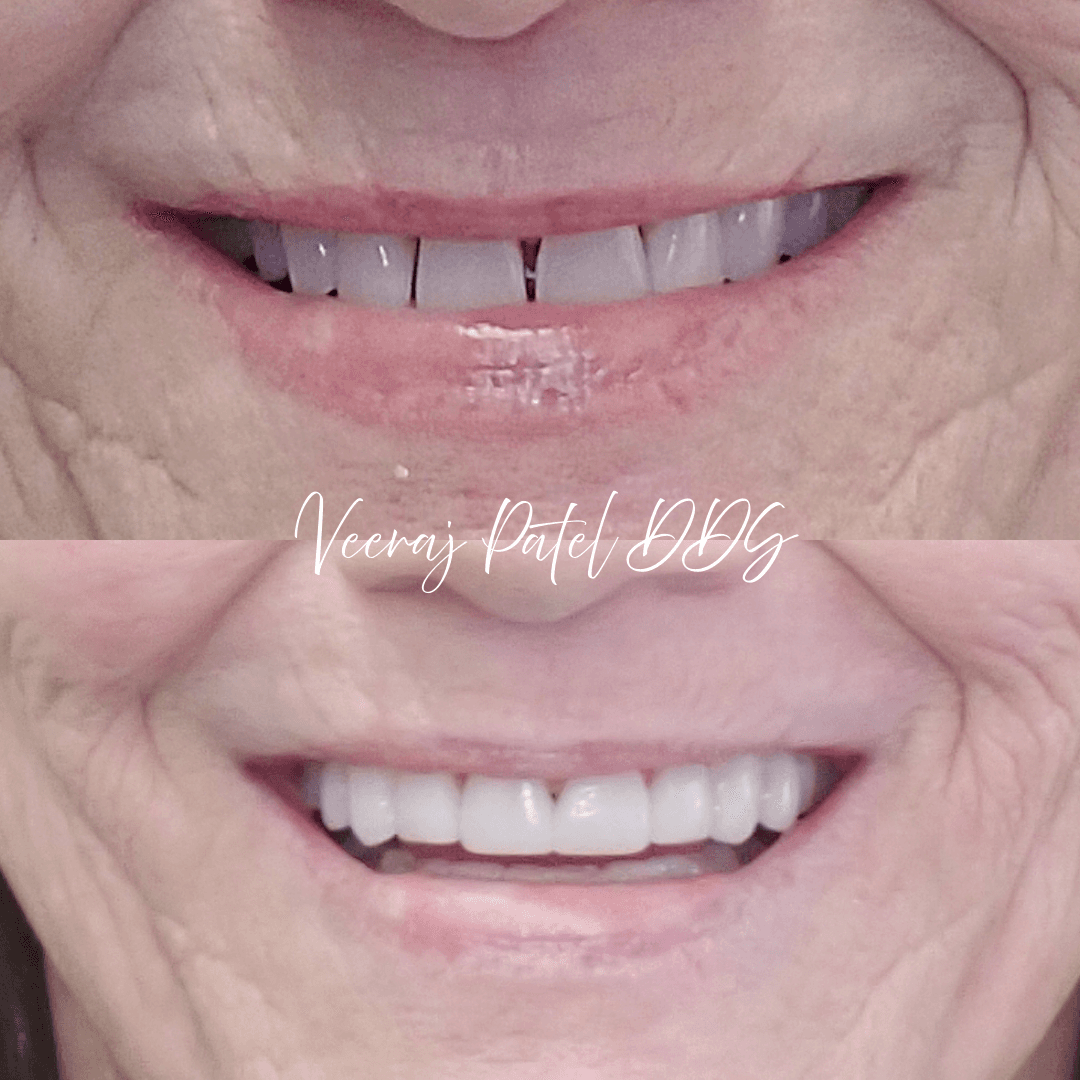 Patient reviewing veneer smile design options
