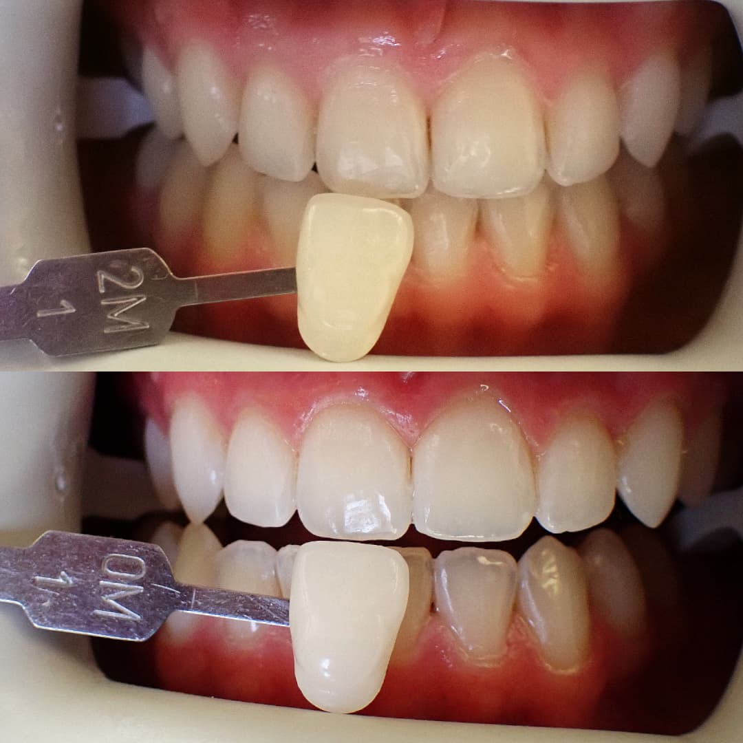 Zoom teeth whitening before and after