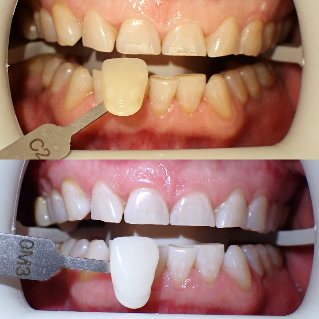 Zoom teeth whitening before and after