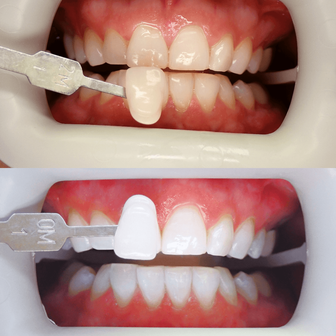 Zoom teeth whitening before and after
