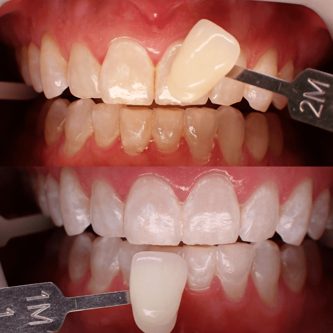 Zoom teeth whitening before and after