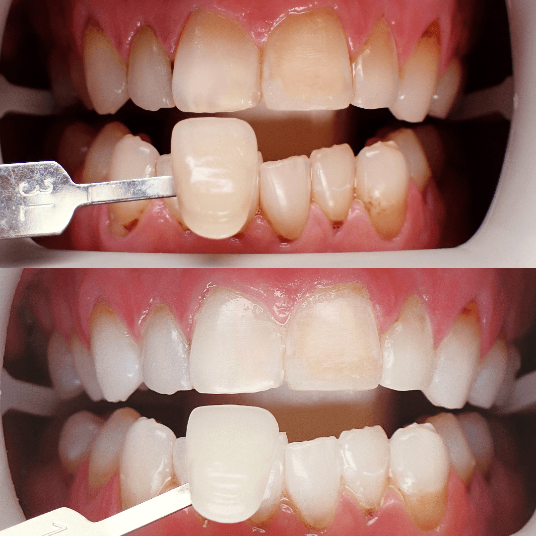 Zoom teeth whitening before and after