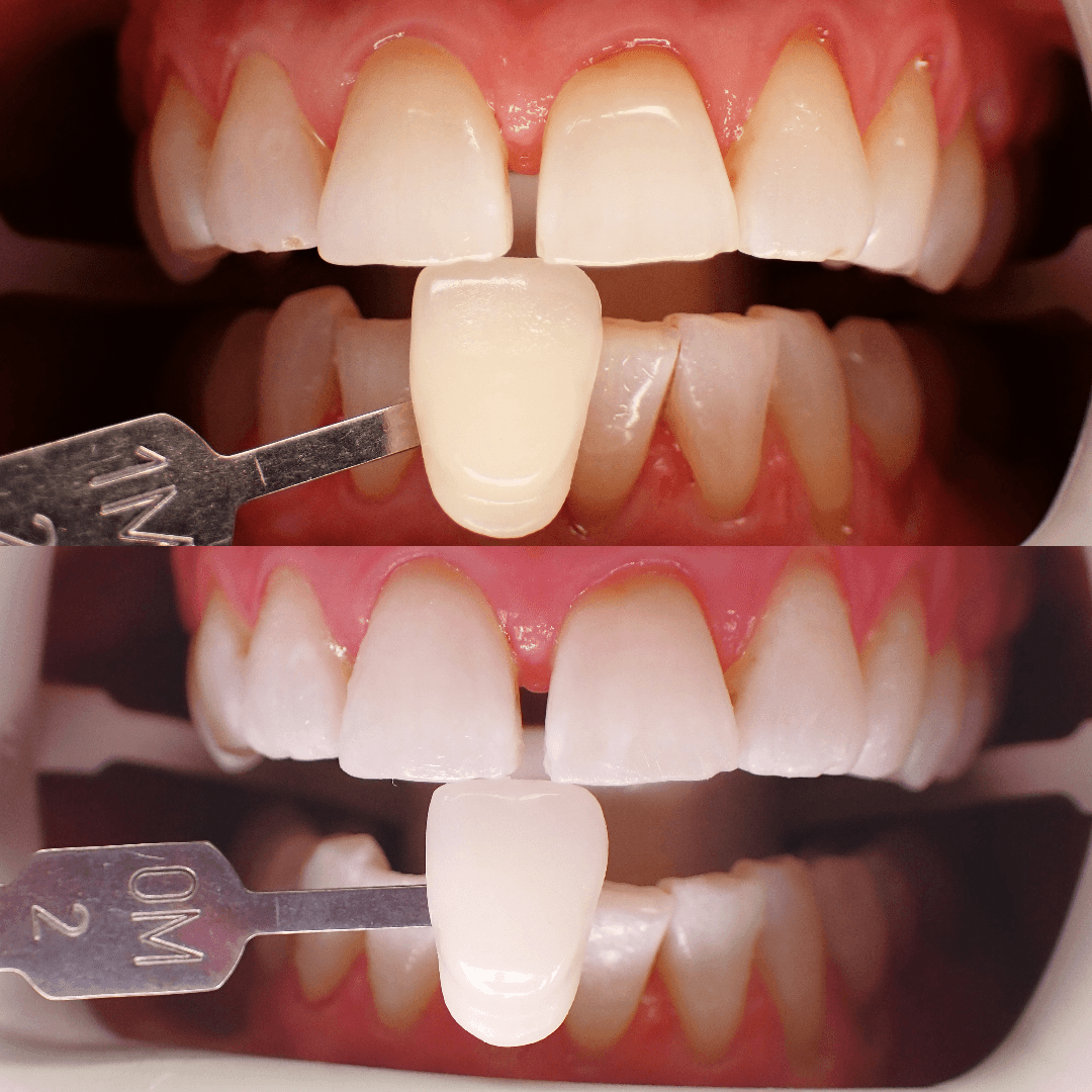 Zoom teeth whitening before and after