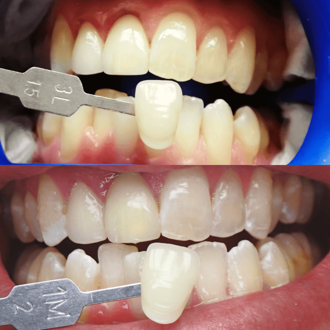 Zoom teeth whitening before and after