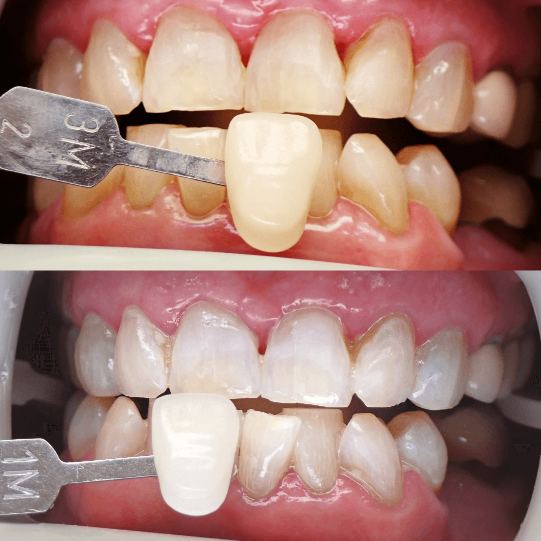 Zoom teeth whitening before and after