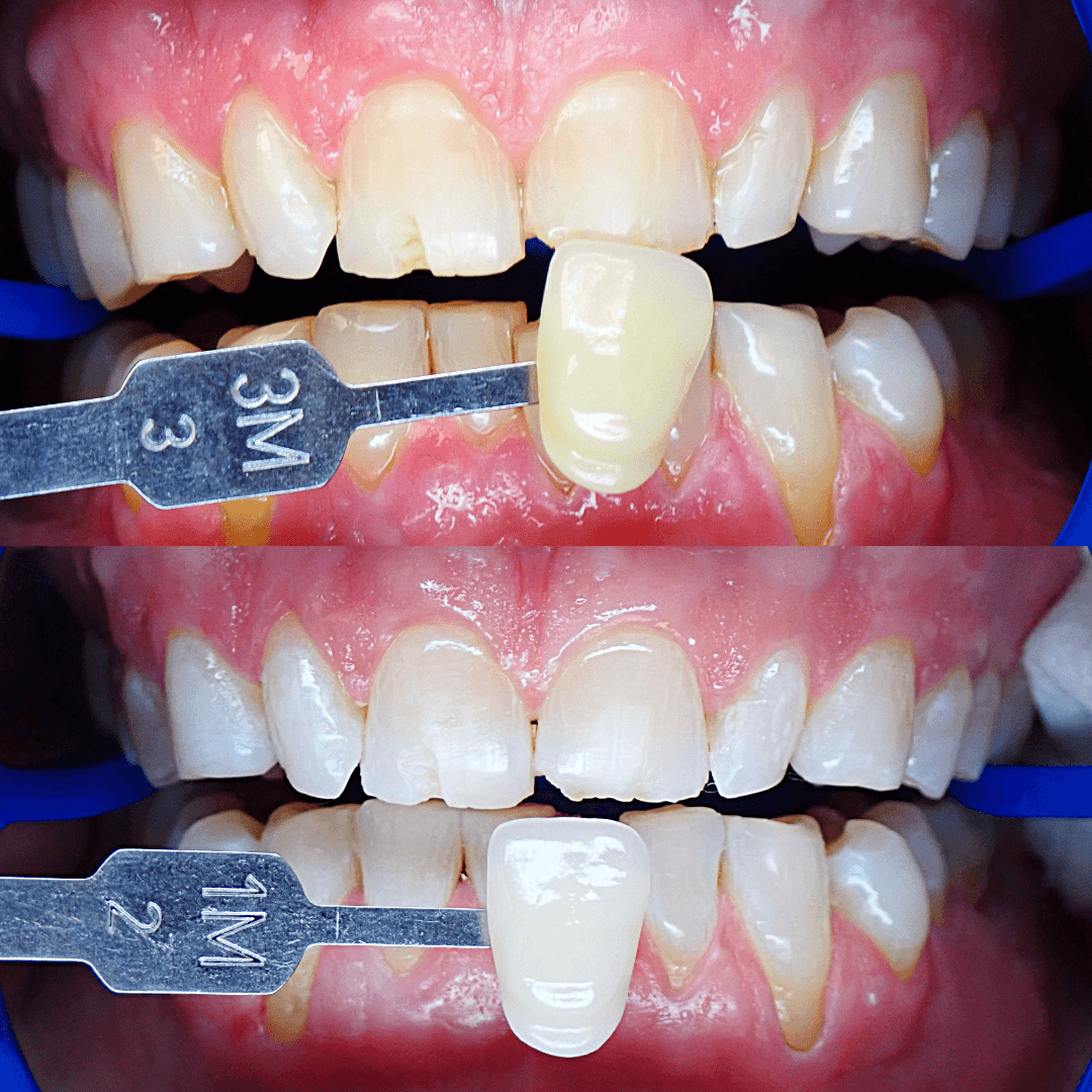 Zoom teeth whitening before and after