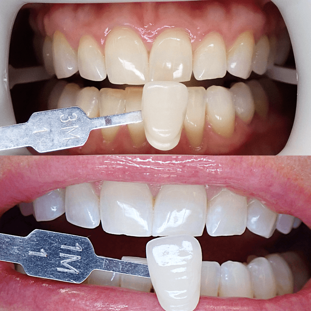 Zoom teeth whitening before and after