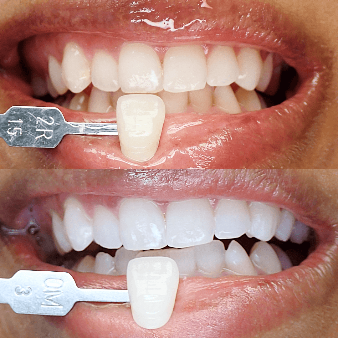 Zoom teeth whitening before and after