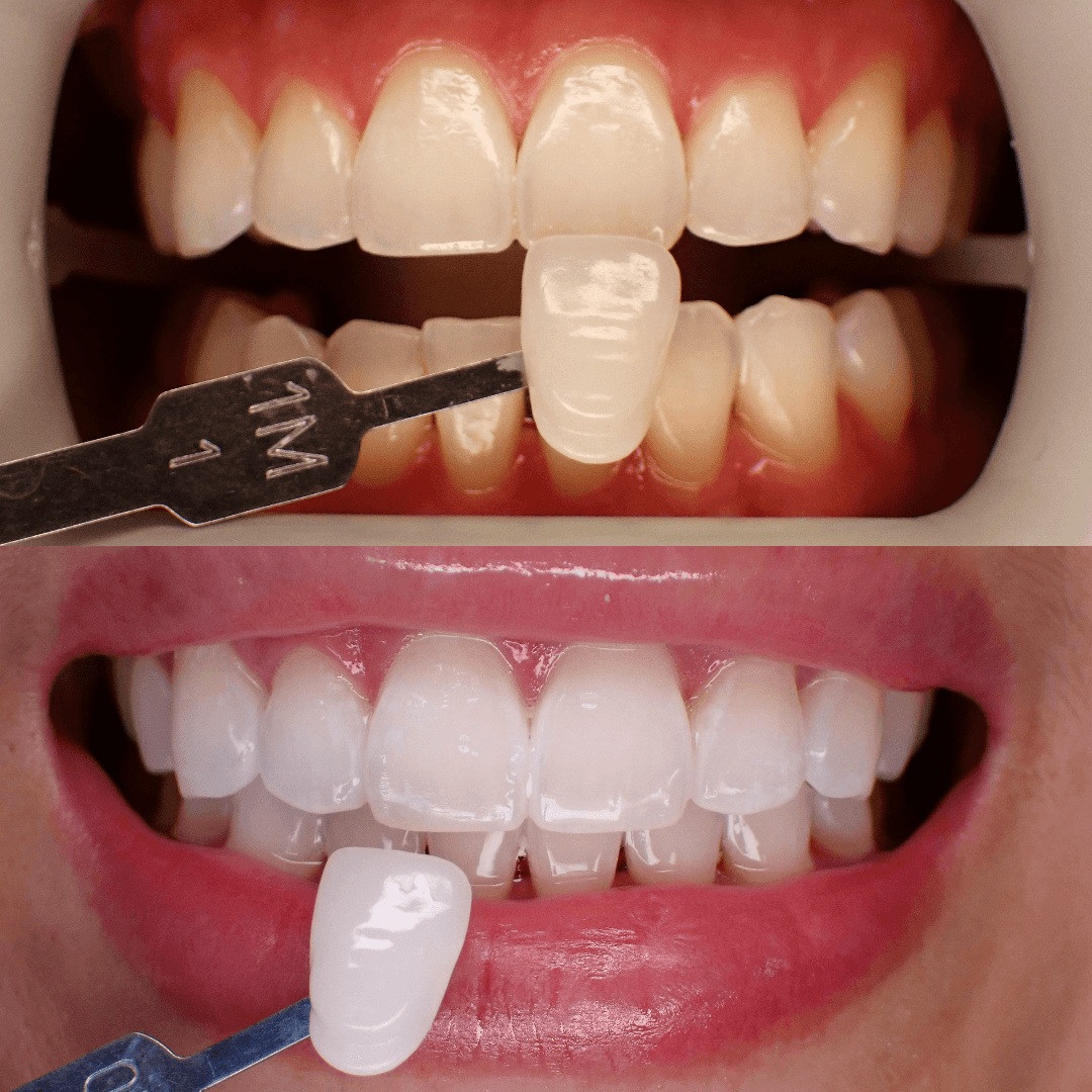 Before and after comparison of professional teeth whitening