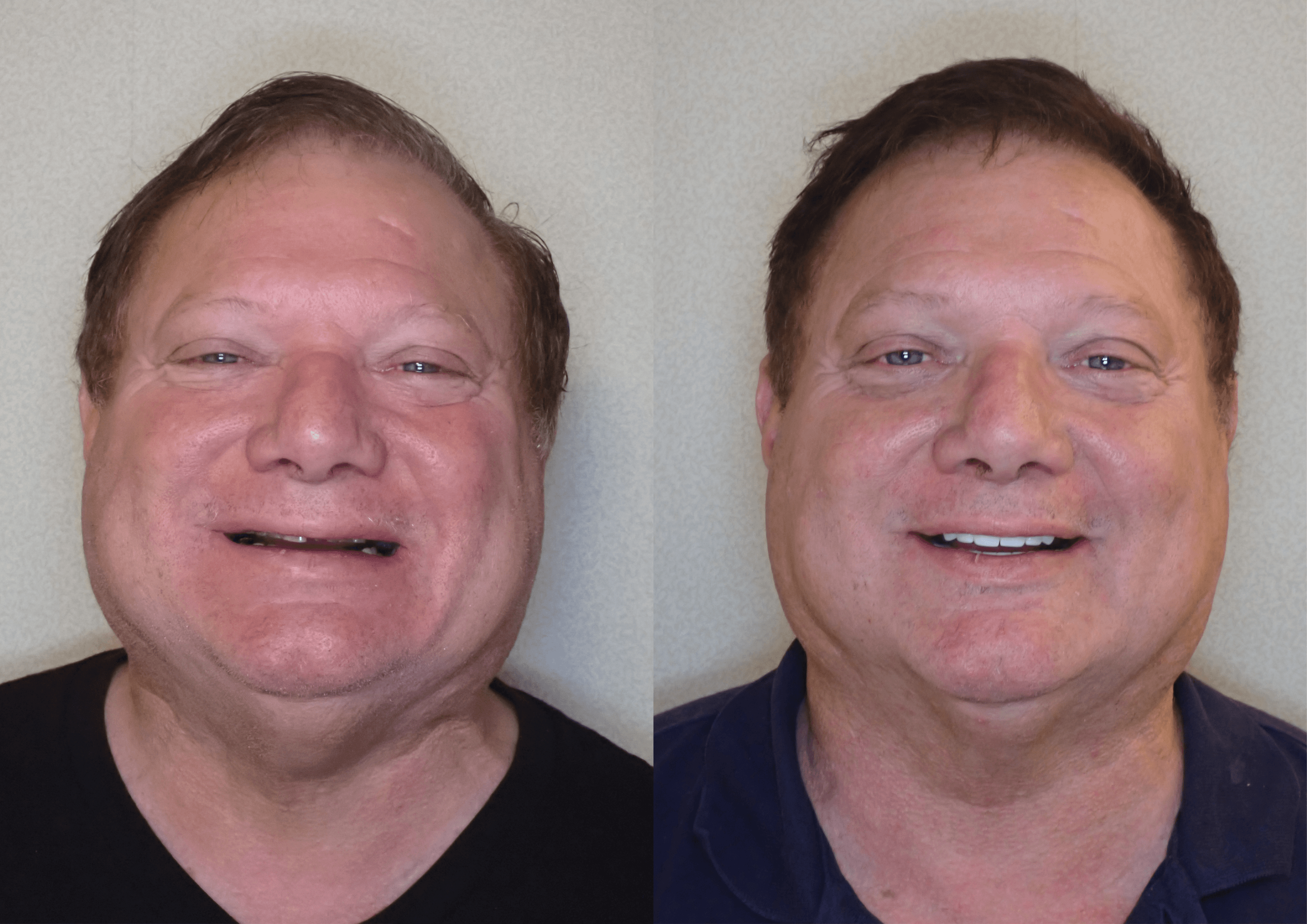 Full Mouth Restoration before and after treatment