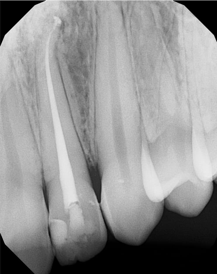 Diagram of a root canal treated tooth